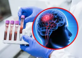 Test de sânge revoluționar pentru detectarea cancerului cerebral, o nouă speranță în medicină