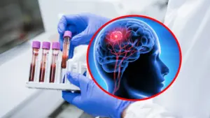 Test de sânge revoluționar pentru detectarea cancerului cerebral, o nouă speranță în medicină