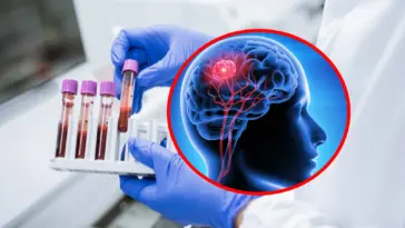 Test de sânge revoluționar pentru detectarea cancerului cerebral, o nouă speranță în medicină