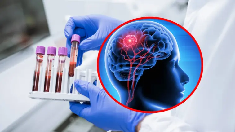 Test de sânge revoluționar pentru detectarea cancerului cerebral, o nouă speranță în medicină